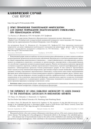 ОПЫТ ПРИМЕНЕНИЯ ТЕМНОПОЛЬНОЙ МИКРОСКОПИИ ДЛЯ ОЦЕНКИ ПОВРЕЖДЕНИЯ ЭНДОТЕЛИАЛЬНОГО ГЛИКОКАЛИКСА ПРИ РЕВМАТОИДНОМ АРТРИТЕ